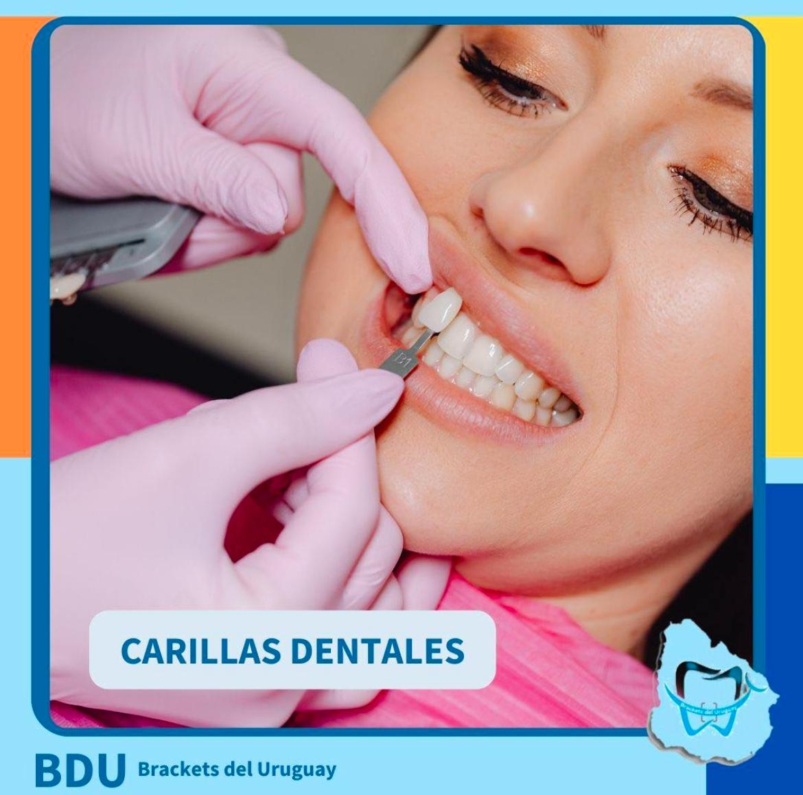 Carillas y estética dental